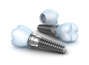 Dental Implants produced with Swiss CNC Machining